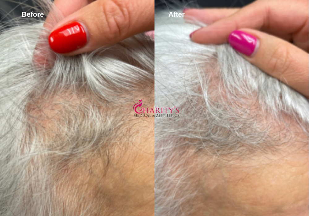 PRP injections for Hair Restoration