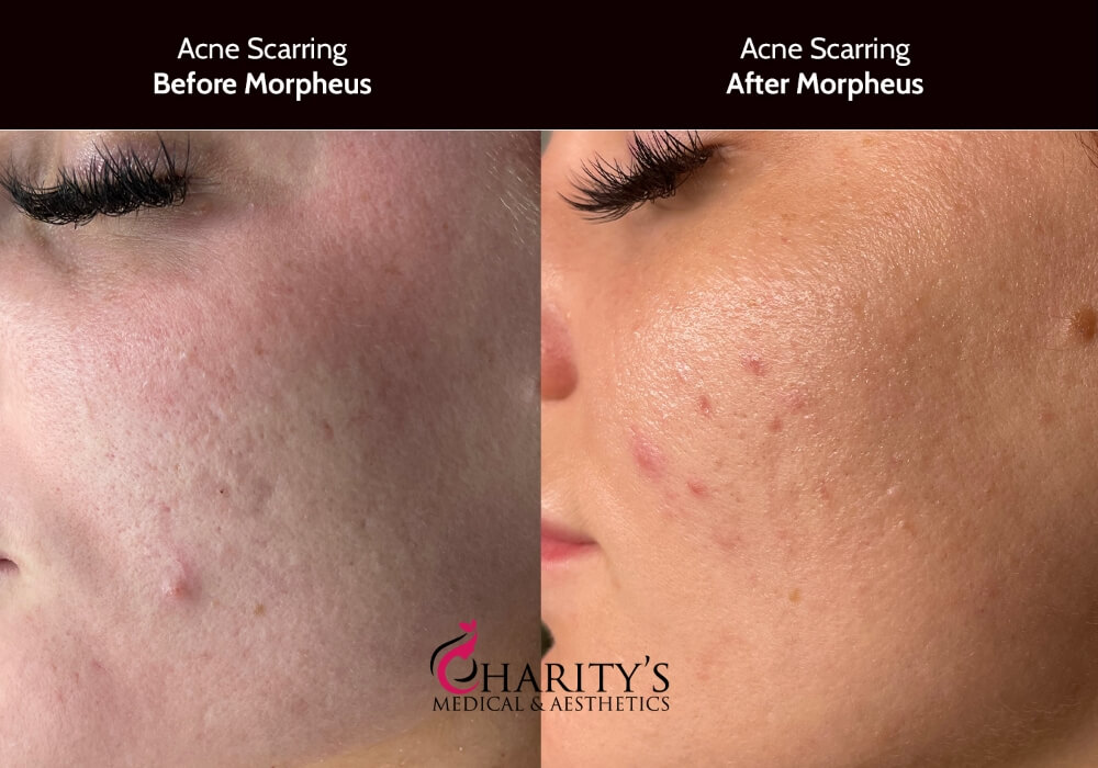 results-opt-morpheus-acne-scars-1